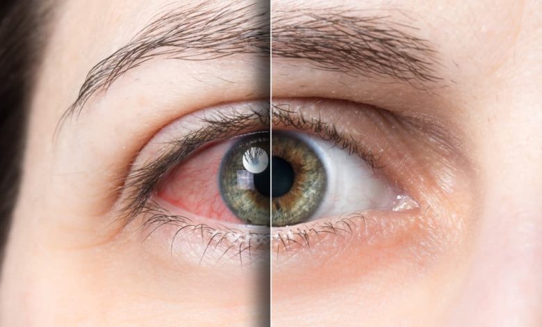 هل حساسية العين تؤثر على النظر؟