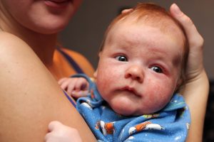 الإكزيما عند الأطفال والرضع