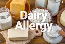 علاج حساسية الحليب عند الرضع